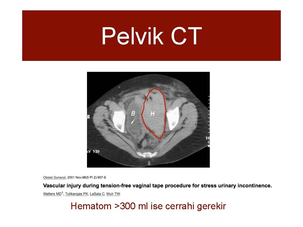 Pelvik CT Hematom >300 ml ise cerrahi gerekir 