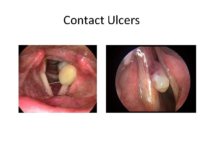 Contact Ulcers 