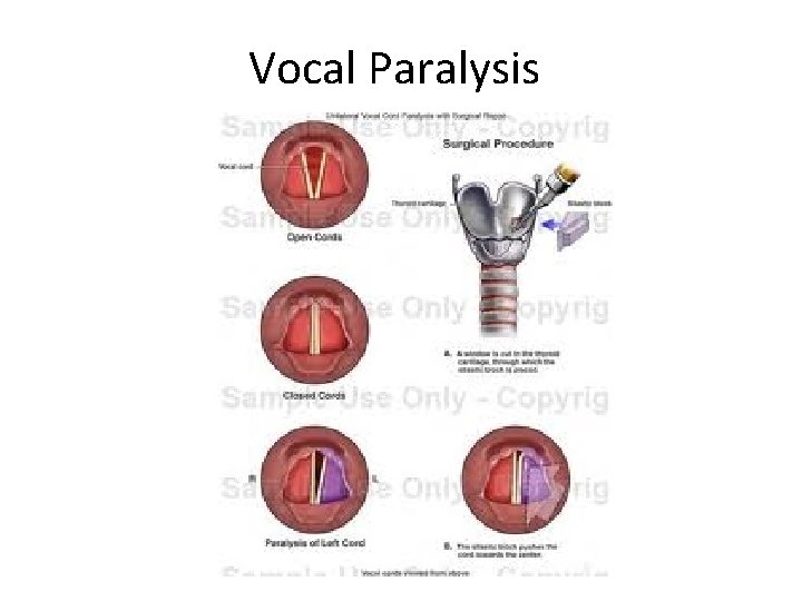 Vocal Paralysis 