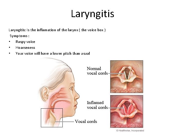 Laryngitis: Is the inflamation of the larynx ( the voice box ) Symptoms :