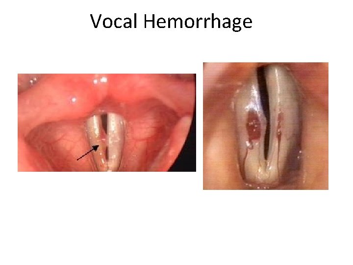 Vocal Hemorrhage 