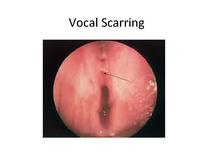 Vocal Scarring 