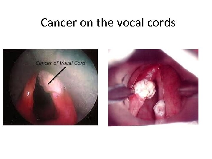 Cancer on the vocal cords 