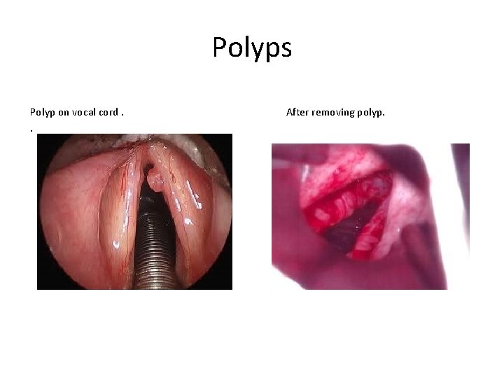 Polyps Polyp on vocal cord. After removing polyp. . 