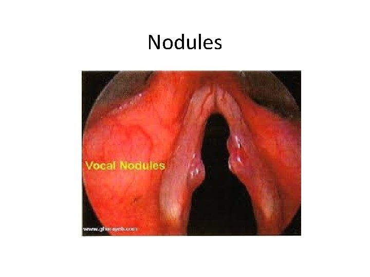 Nodules 