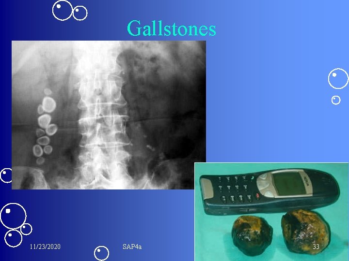 Gallstones 11/23/2020 SAP 4 a 33 