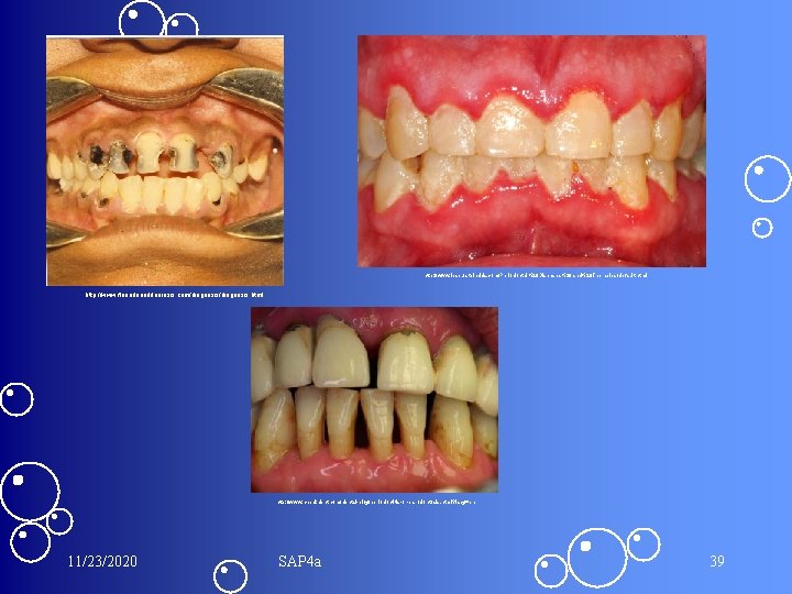 http: //www. lesbursteindds. com/Periodontal%20 Diseases%20 and%20 Therapies/default. html http: //www. fluorideandfluorosis. com/diagnosis. html http: