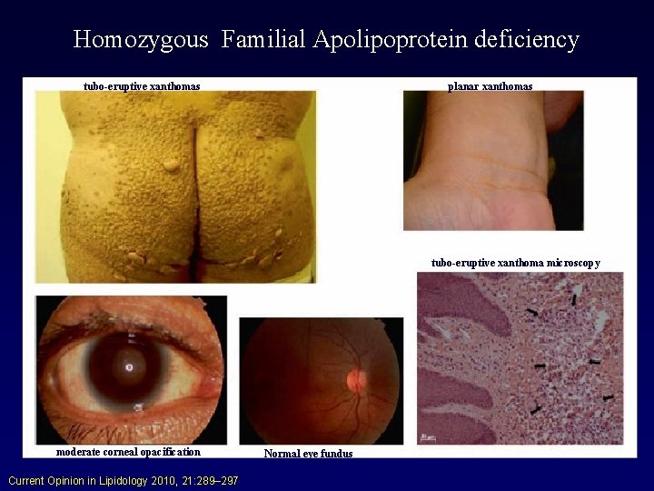 Homozygous Familial Apolipoprotein deficiency tubo-eruptive xanthomas planar xanthomas tubo-eruptive xanthoma microscopy moderate corneal opacification