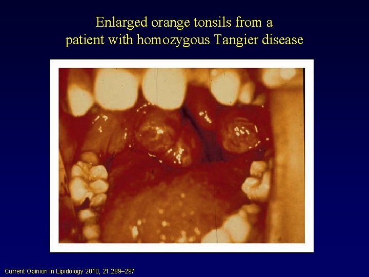 Enlarged orange tonsils from a patient with homozygous Tangier disease Current Opinion in Lipidology