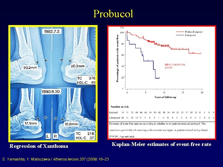 Probucol Regression of Xanthoma S. Yamashita, Y. Matsuzawa / Atherosclerosis 207 (2009) 16– 23