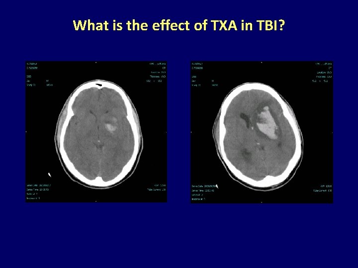 What is the effect of TXA in TBI? 