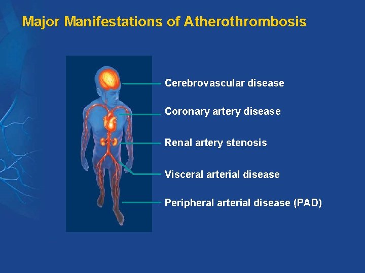 Major Manifestations of Atherothrombosis Cerebrovascular disease Coronary artery disease Renal artery stenosis Visceral arterial
