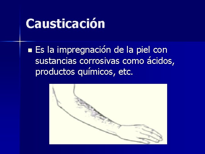 Causticación n Es la impregnación de la piel con sustancias corrosivas como ácidos, productos