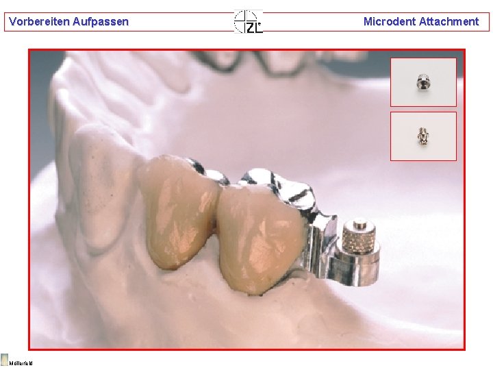 Vorbereiten Aufpassen Möllerfeld Microdent Attachment 