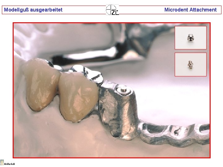 Modellguß ausgearbeitet Möllerfeld Microdent Attachment 