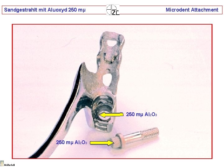 Sandgestrahlt mit Aluoxyd 250 mµ Microdent Attachment 250 mµ Al 2 O 3 Möllerfeld