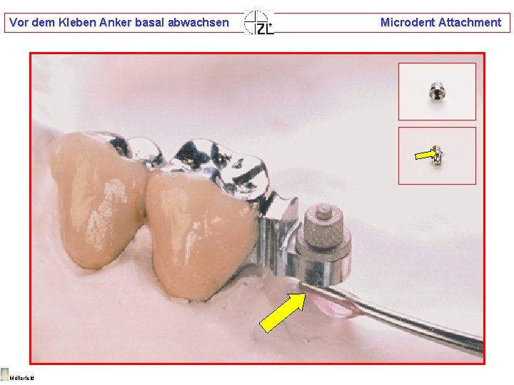 Vor dem Kleben Anker basal abwachsen Möllerfeld Microdent Attachment 