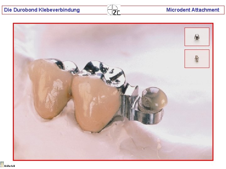 Die Durobond Klebeverbindung Möllerfeld Microdent Attachment 