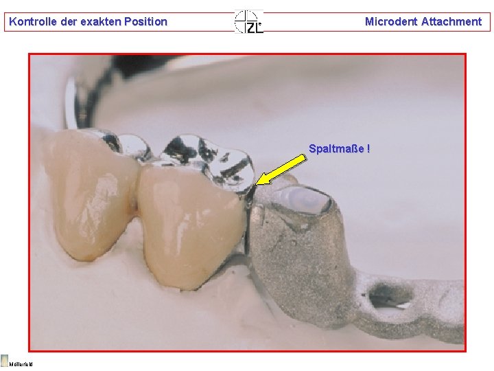 Kontrolle der exakten Position Microdent Attachment Spaltmaße ! Möllerfeld 