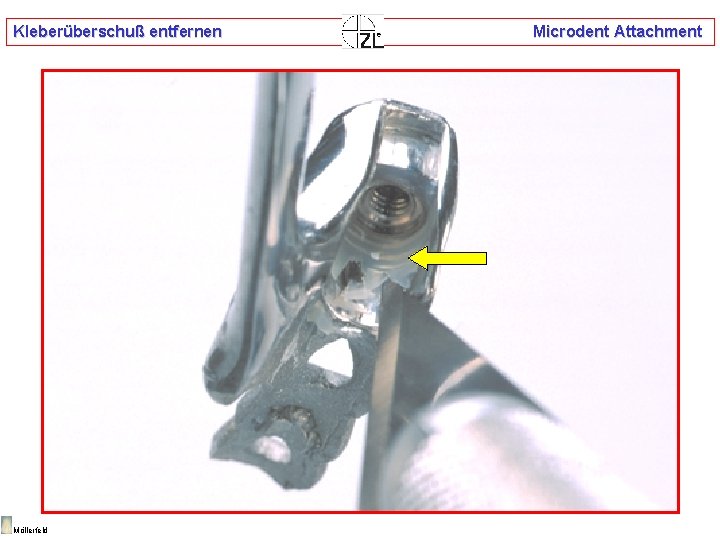 Kleberüberschuß entfernen Möllerfeld Microdent Attachment 
