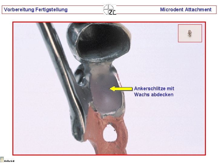 Vorbereitung Fertigstellung Microdent Attachment Ankerschlitze mit Wachs abdecken Möllerfeld 