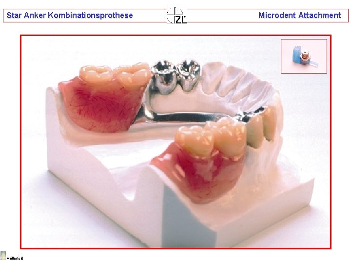 Star Anker Kombinationsprothese Möllerfeld Microdent Attachment 