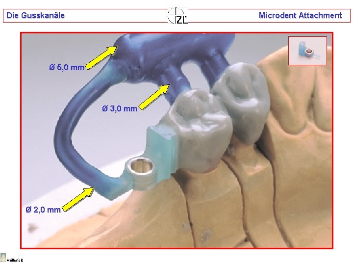 Die Gusskanäle Microdent Attachment Ø 5, 0 mm Ø 3, 0 mm Ø 2,