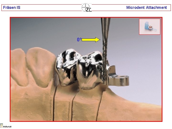 Fräsen IS Microdent Attachment 0° Möllerfeld 