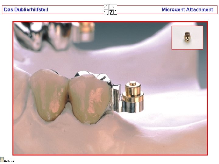 Das Dublierhilfsteil Möllerfeld Microdent Attachment 