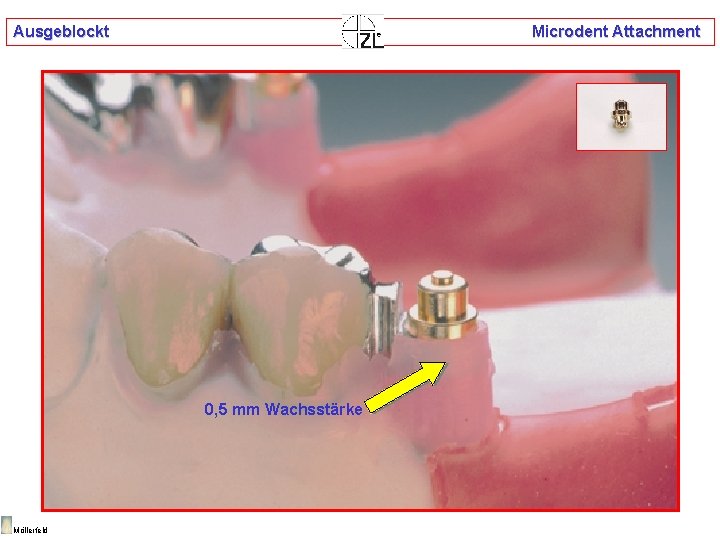 Ausgeblockt Microdent Attachment 0, 5 mm Wachsstärke Möllerfeld 