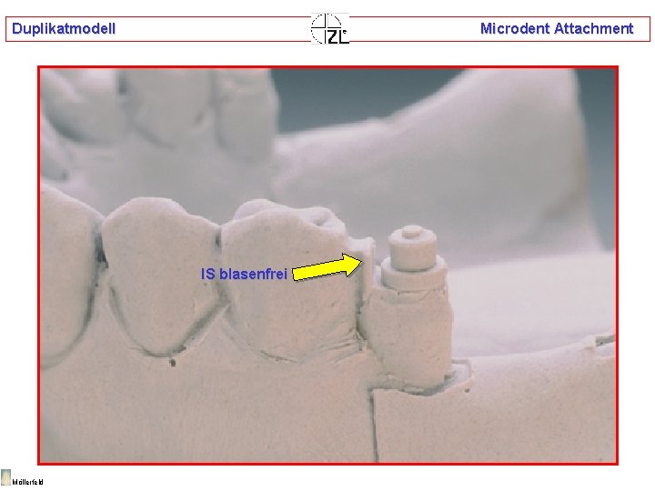 Duplikatmodell Microdent Attachment IS blasenfrei Möllerfeld 