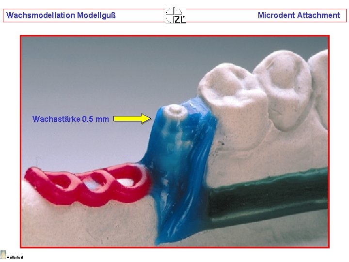 Wachsmodellation Modellguß Wachsstärke 0, 5 mm Möllerfeld Microdent Attachment 