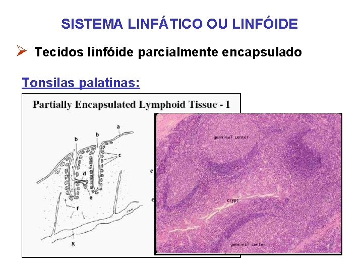 SISTEMA LINFÁTICO OU LINFÓIDE Ø Tecidos linfóide parcialmente encapsulado Tonsilas palatinas: SISTEMA LINFÁTICO OU LINFÓIDE Ø Tecidos linfóide parcialmente encapsulado Tonsilas palatinas: