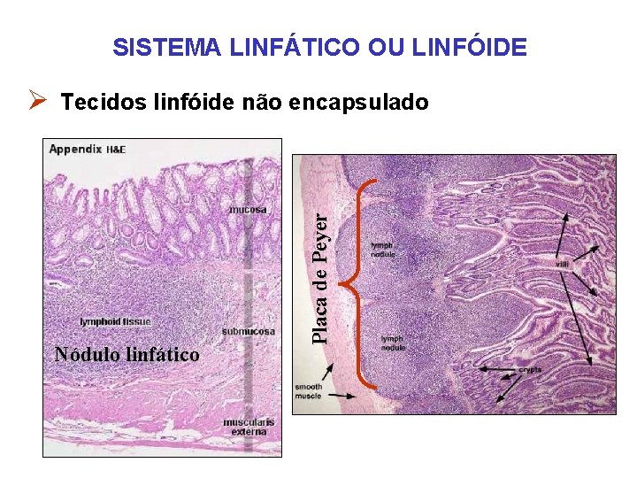 SISTEMA LINFÁTICO OU LINFÓIDE Nódulo linfático Placa de Peyer Ø Tecidos linfóide não encapsulado SISTEMA LINFÁTICO OU LINFÓIDE Nódulo linfático Placa de Peyer Ø Tecidos linfóide não encapsulado