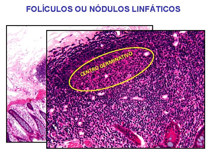 FOLÍCULOS OU NÓDULOS LINFÁTICOS TL DENSO NODULAR O C O R T EN IV FOLÍCULOS OU NÓDULOS LINFÁTICOS TL DENSO NODULAR O C O R T EN IV