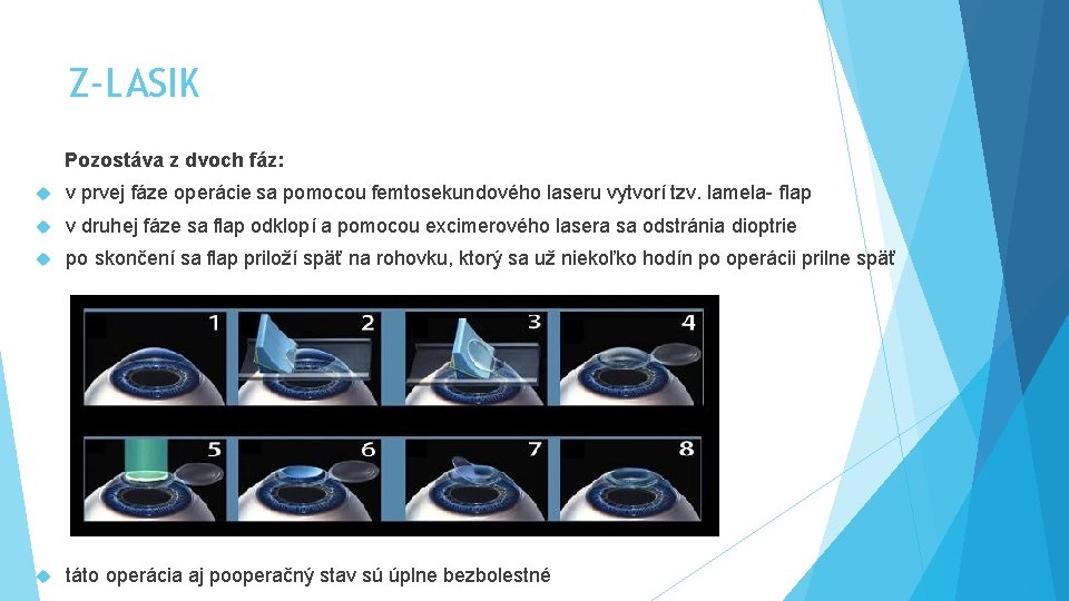 Z-LASIK Pozostáva z dvoch fáz: v prvej fáze operácie sa pomocou femtosekundového laseru vytvorí