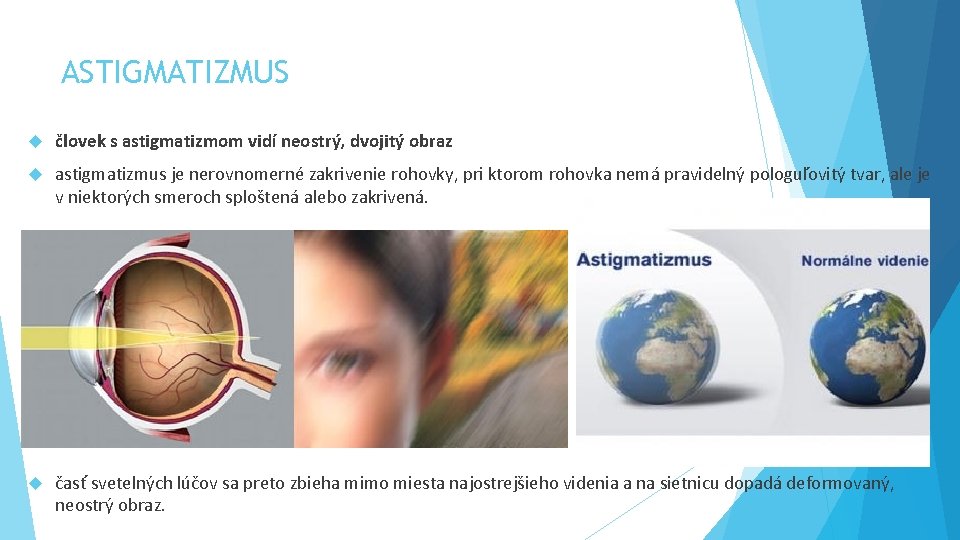 ASTIGMATIZMUS človek s astigmatizmom vidí neostrý, dvojitý obraz astigmatizmus je nerovnomerné zakrivenie rohovky, pri