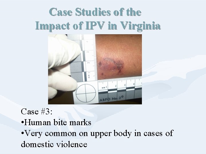 Case Studies of the Impact of IPV in Virginia Case #3: • Human bite