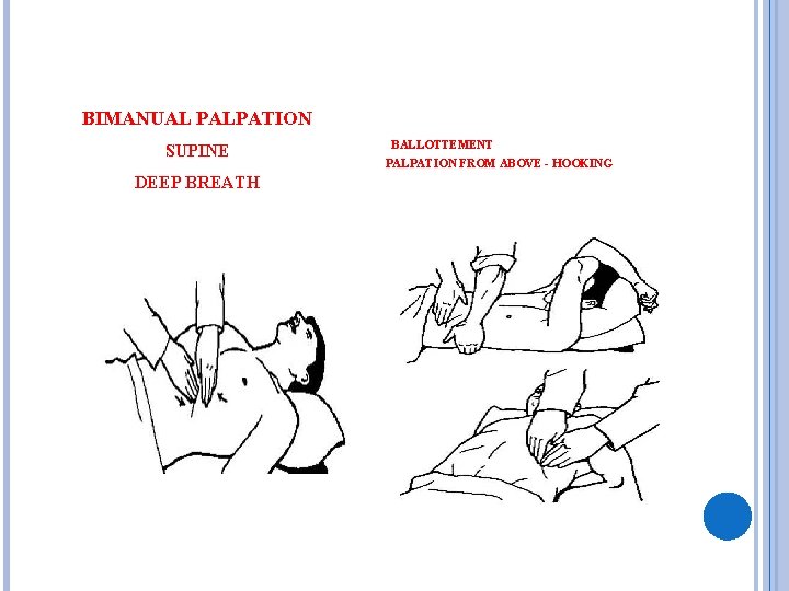 BIMANUAL PALPATION SUPINE DEEP BREATH BALLOTTEMENT PALPATION FROM ABOVE - HOOKING 