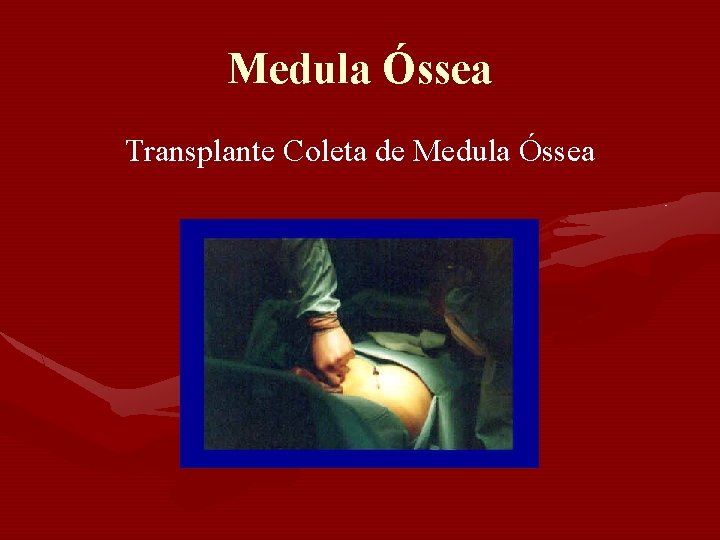 Medula Óssea Transplante Coleta de Medula Óssea Medula Óssea Transplante Coleta de Medula Óssea