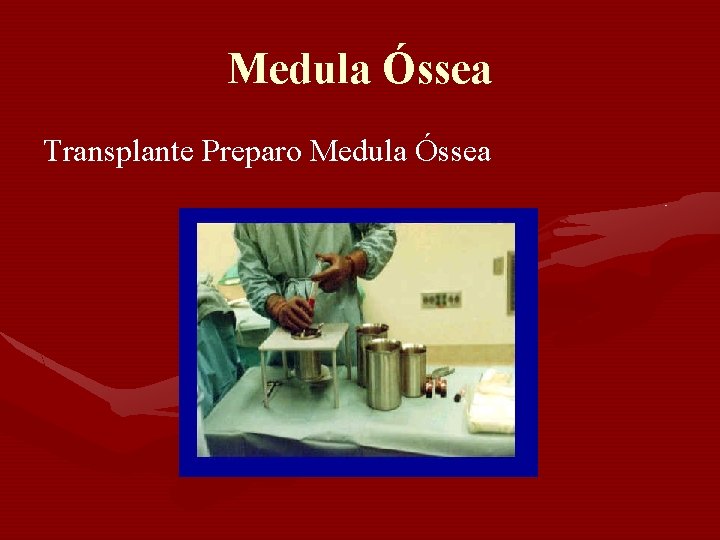 Medula Óssea Transplante Preparo Medula Óssea Medula Óssea Transplante Preparo Medula Óssea