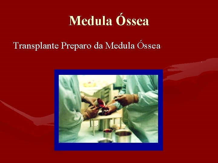 Medula Óssea Transplante Preparo da Medula Óssea Medula Óssea Transplante Preparo da Medula Óssea