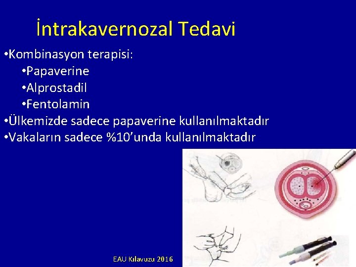 İntrakavernozal Tedavi • Kombinasyon terapisi: • Papaverine • Alprostadil • Fentolamin • Ülkemizde sadece