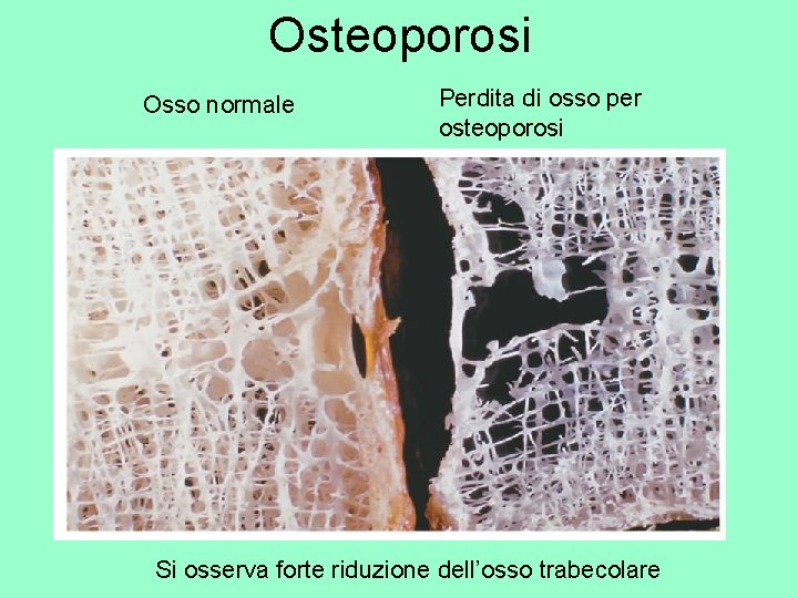 Osteoporosi Osso normale Perdita di osso per osteoporosi Si osserva forte riduzione dell’osso trabecolare