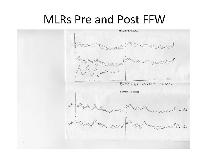 MLRs Pre and Post FFW 