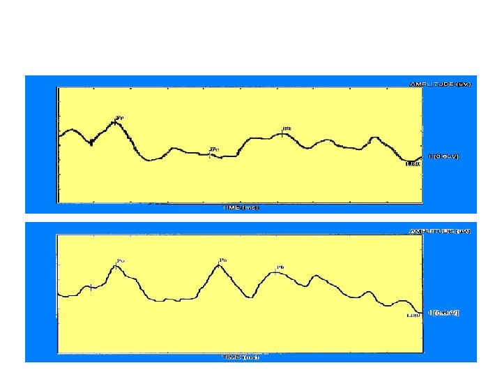 MLRs Pre and Post FFW 