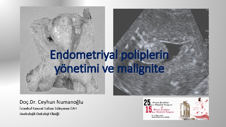 Endometriyal poliplerin yönetimi ve malignite Doç. Dr. Ceyhun Numanoğlu İstanbul Kanuni Sultan Süleyman EAH