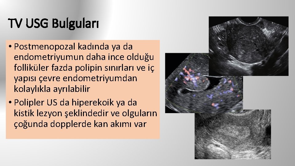 TV USG Bulguları • Postmenopozal kadında ya da endometriyumun daha ince olduğu folliküler fazda