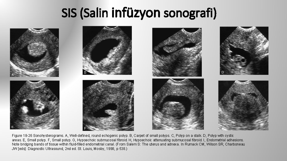 SIS (Salin infüzyon sonografi) Figure 18 -26 Sonohysterograms. A, Well-defined, round echogenic polyp. B,