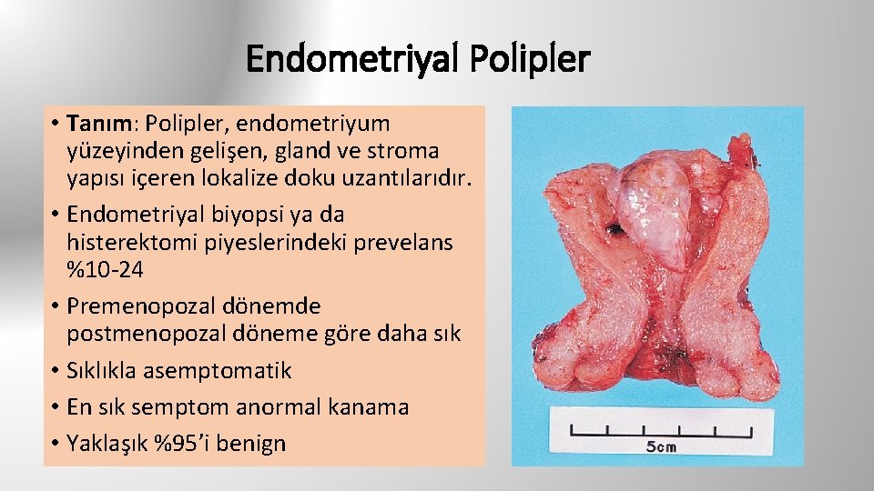 Endometriyal Polipler • Tanım: Polipler, endometriyum yüzeyinden gelişen, gland ve stroma yapısı içeren lokalize